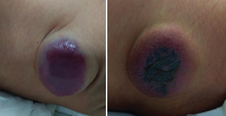 (A) Lesion over the lower back before sirolimus therapy. (B) Image taken at three weeks after sirolimus therapy (notice reduced size and fading of the lesion).